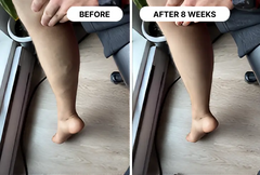 No more varicose veins in 1 month!